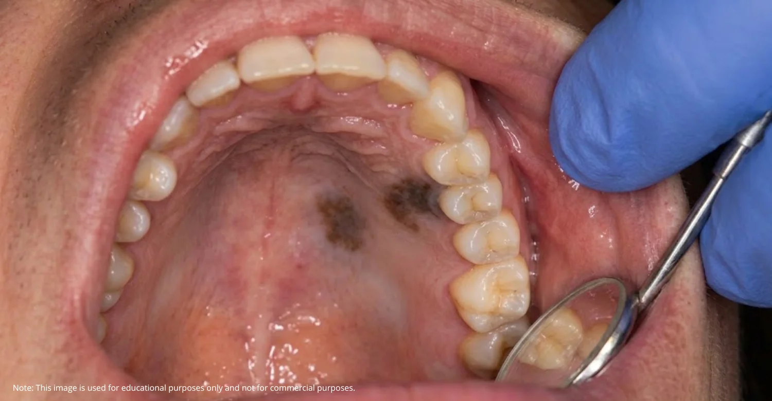 Oral Mucosal Melanoma INBLOG